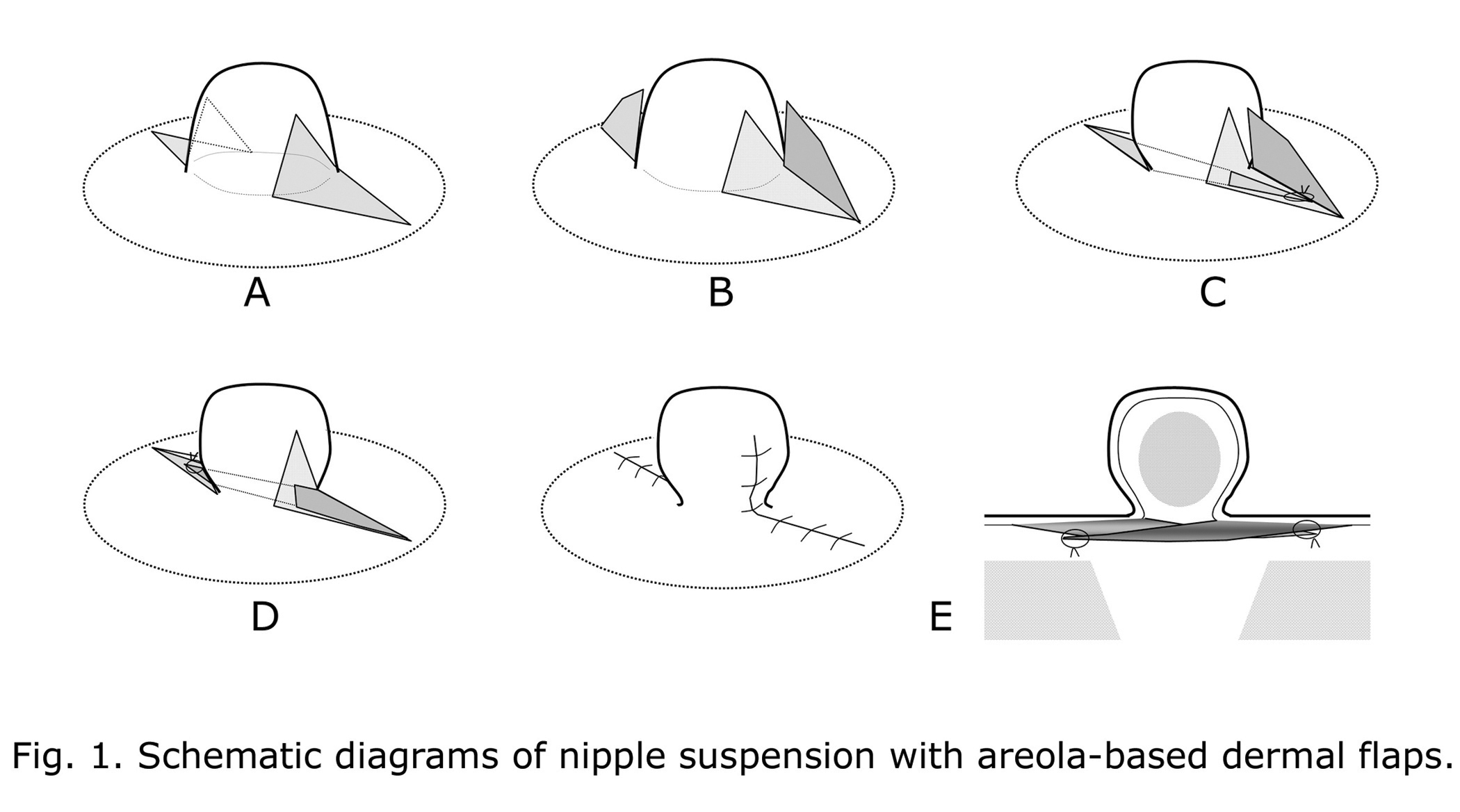 Correction Of Inverted Nipple Using Nipple Suspension With Areola Based