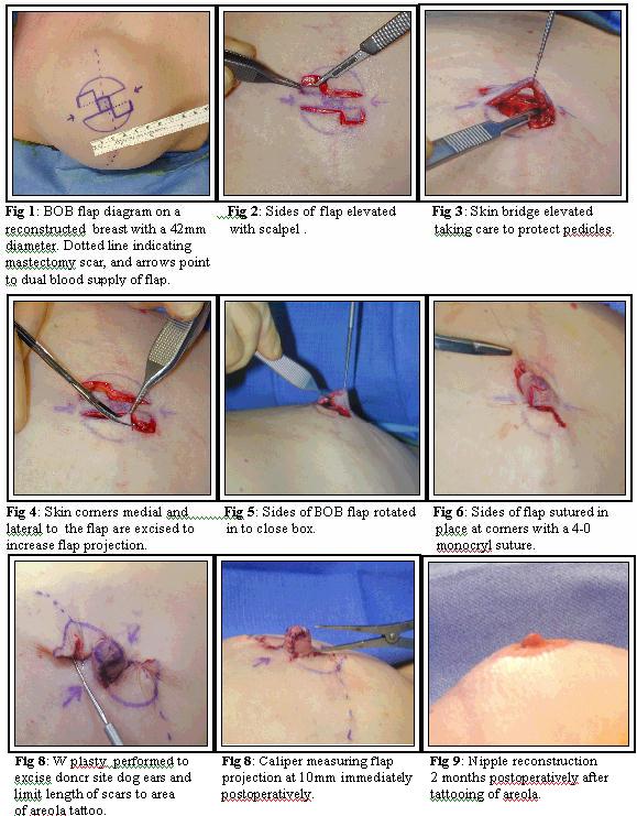 a reconstructed nipple before placement of foam nipple guard