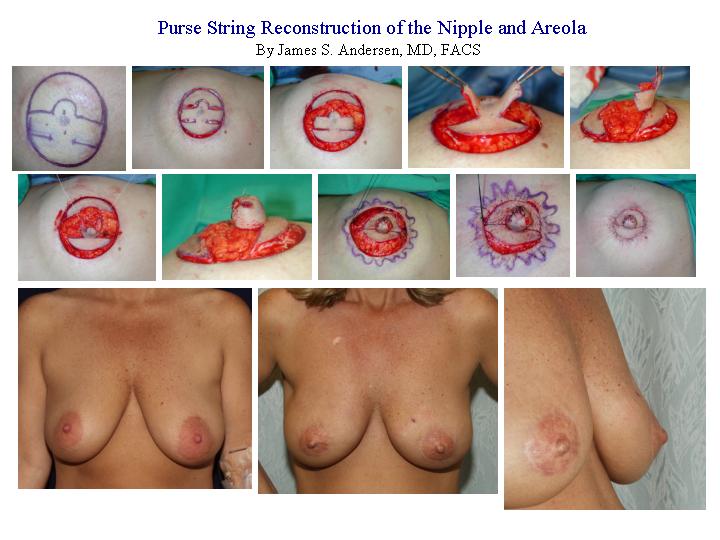 Breast inflammation