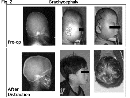 cranial vault expansion