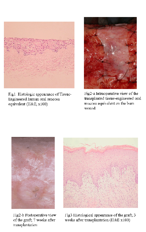 normal oral mucosa