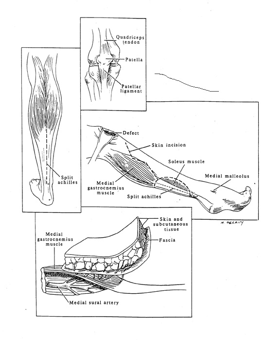 Sural Flap