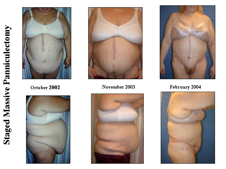 Panniculectomy in patients with super obesity