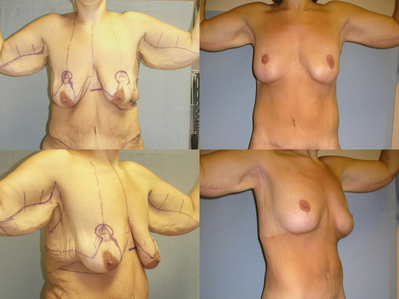Introduction: After massive weight loss, the breasts have poor shape, proje...