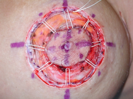 The Interlocking Gore-Tex Suture for Control of Areolar Diameter