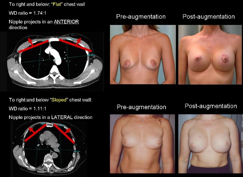 Linear breast measurements: (A) mid-calvicular to nipple, (B)