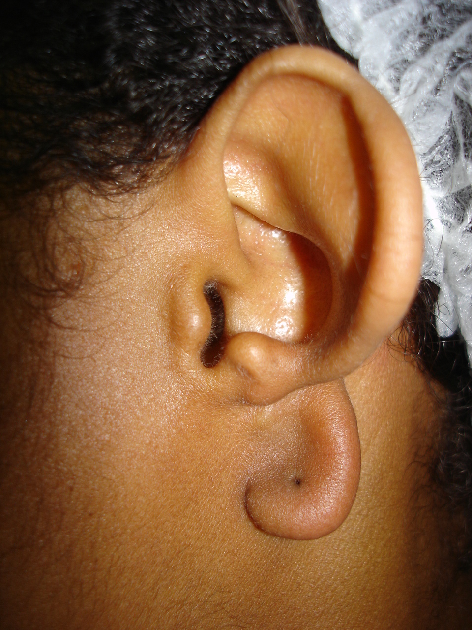 Patient 2 before surgery - left ear.JPG