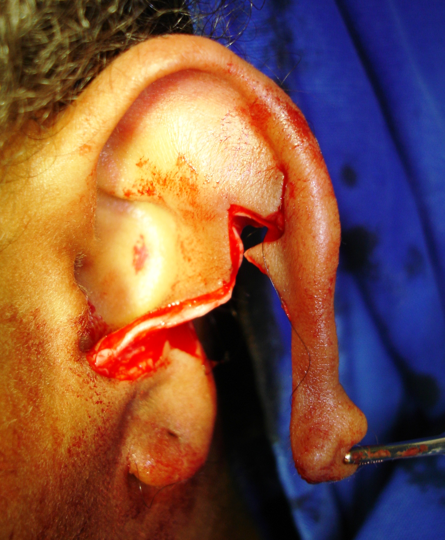 Patient 2 - sliding flap - left ear.JPG