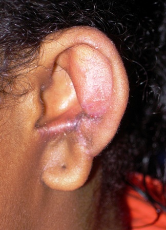 Patient 2 after 6 month - left ear.JPG