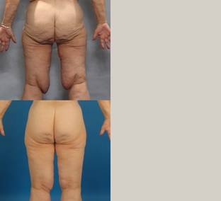 The same patient as in Figure 1 following belt lipectomy. The