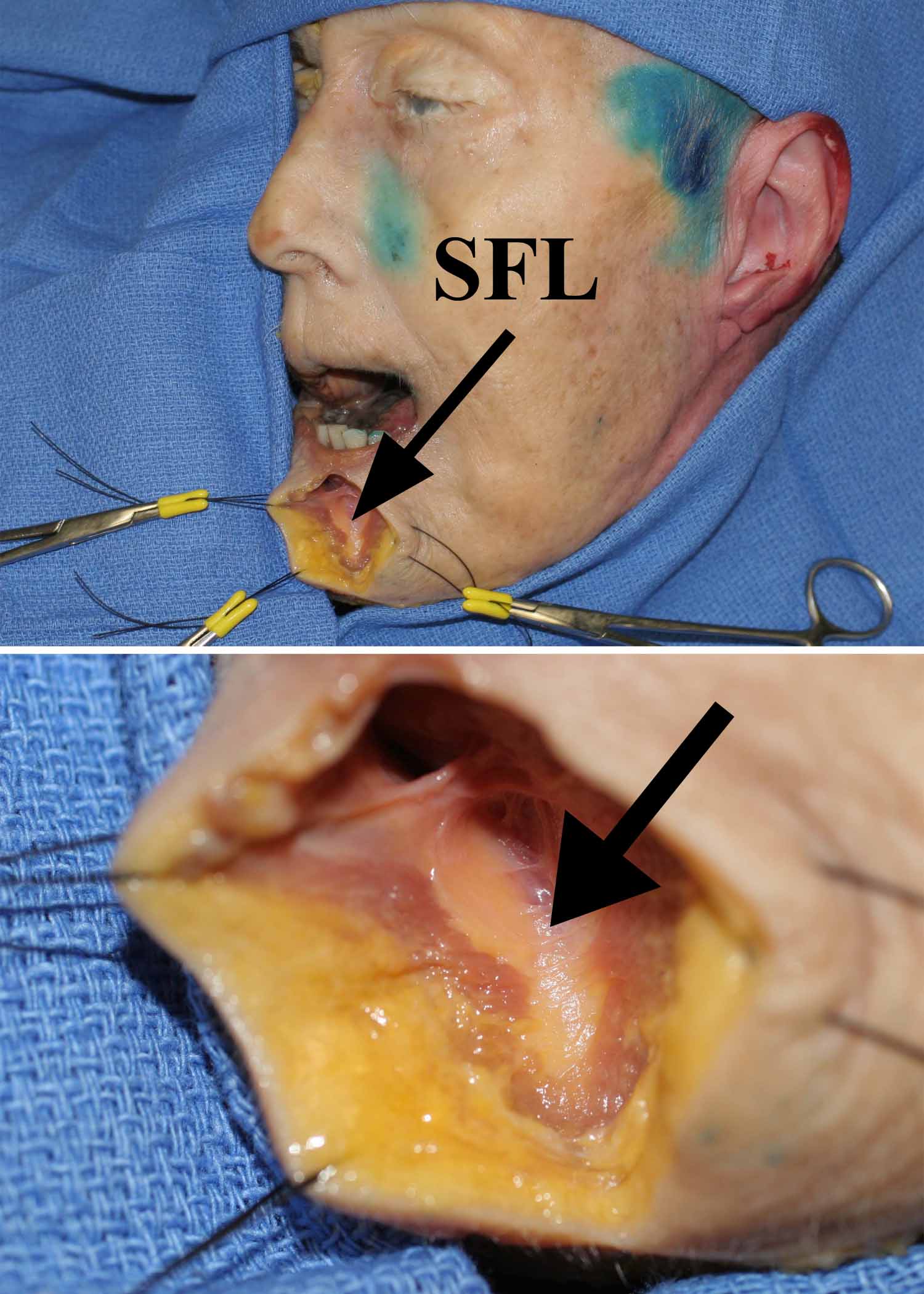 The Sub Orbicularis Oris Fat of the Upper and Lower Lips SFL